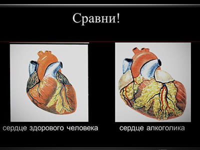 Алкогольная болезнь сердца и сосудов и легких